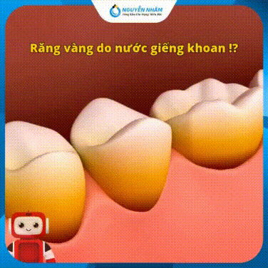 ⚠️ Vì sao nước giếng khoan làm răng bị vàng?